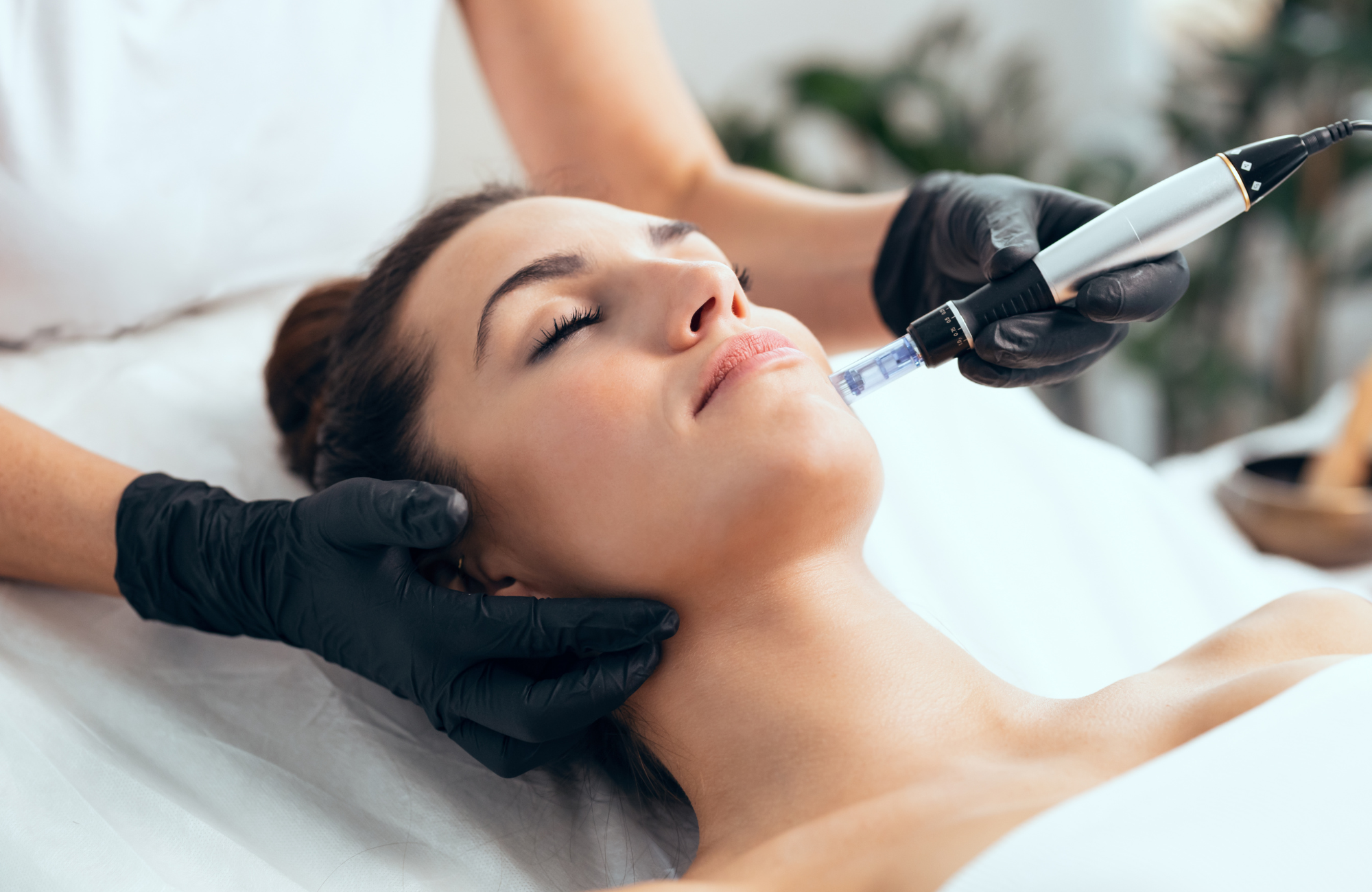 Microneedling – sve što trebate znati prije nego se odlučite za tretman